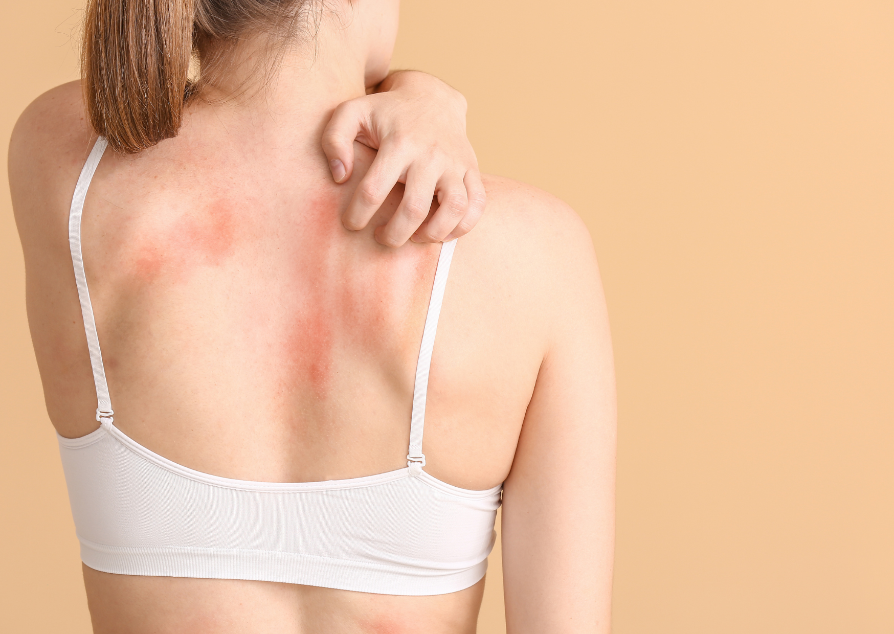 Eczema, the skin condition that can make life a real itch. Treat it with Tallow!